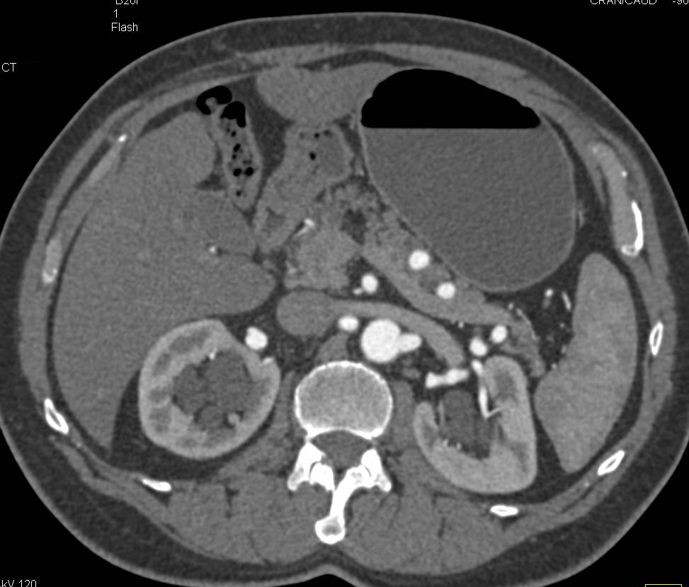 Right Renal Artery Aneurysm and Parapelvic Cysts - CTisus CT Scan