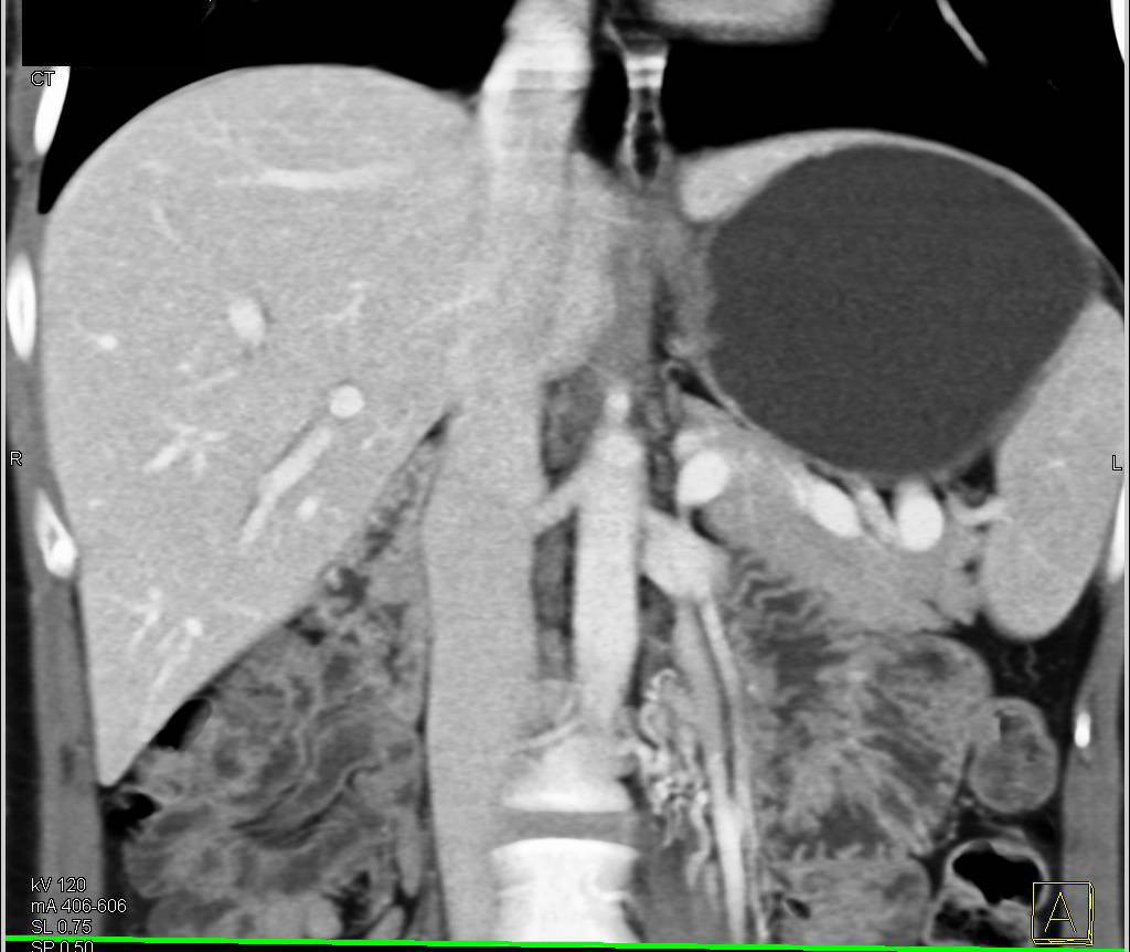 Prominent Left Gonadal Vein and Ovarian Artery - CTisus CT Scan