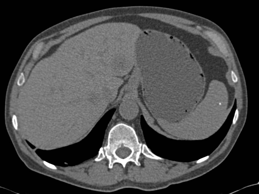 Clear Cell Renal Cell Carcinoma with Liver Metastases - CTisus CT Scan