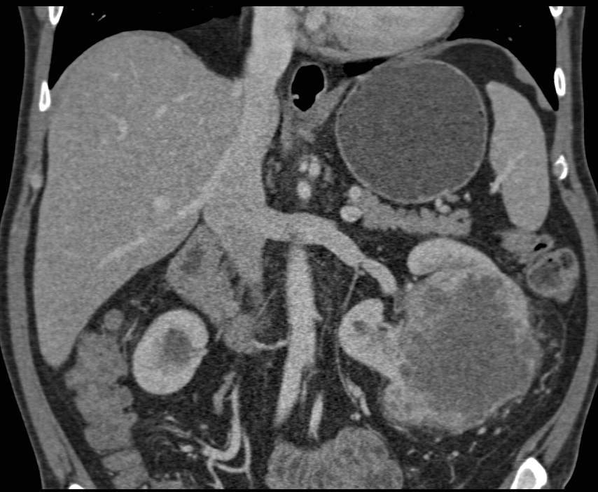 Clear Cell Renal Cell Carcinoma in Multiple Phases - CTisus CT Scan