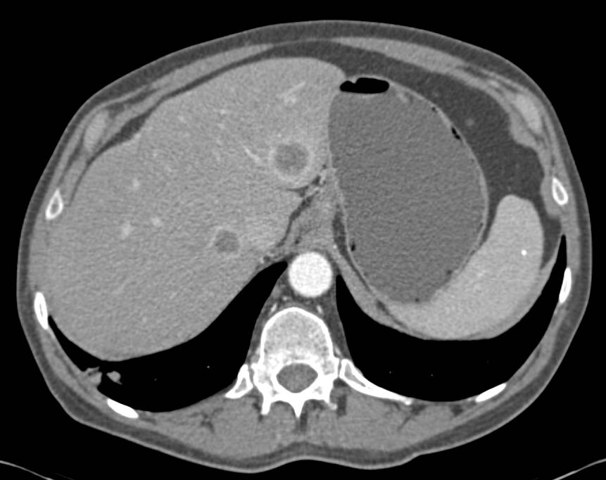 Renal Cell Carcinoma with Liver Metastases - CTisus CT Scan