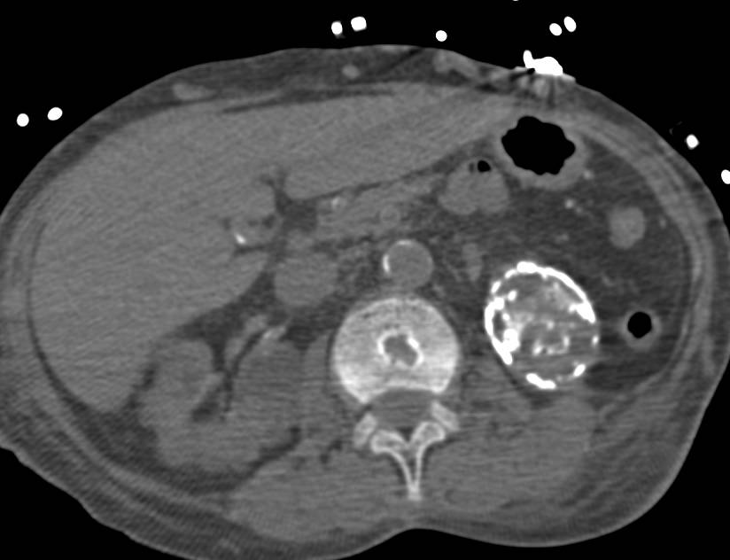 Infarcted Left Kidney - CTisus CT Scan