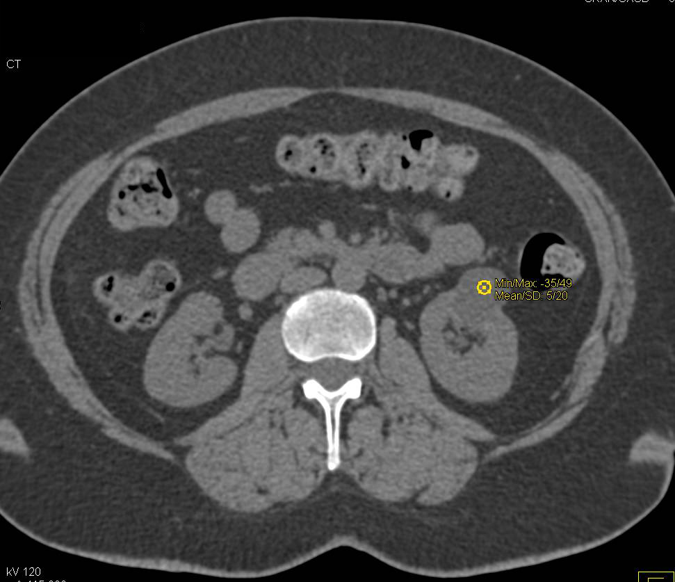 Bosniak I Renal Cyst on Multiple Phases - CTisus CT Scan