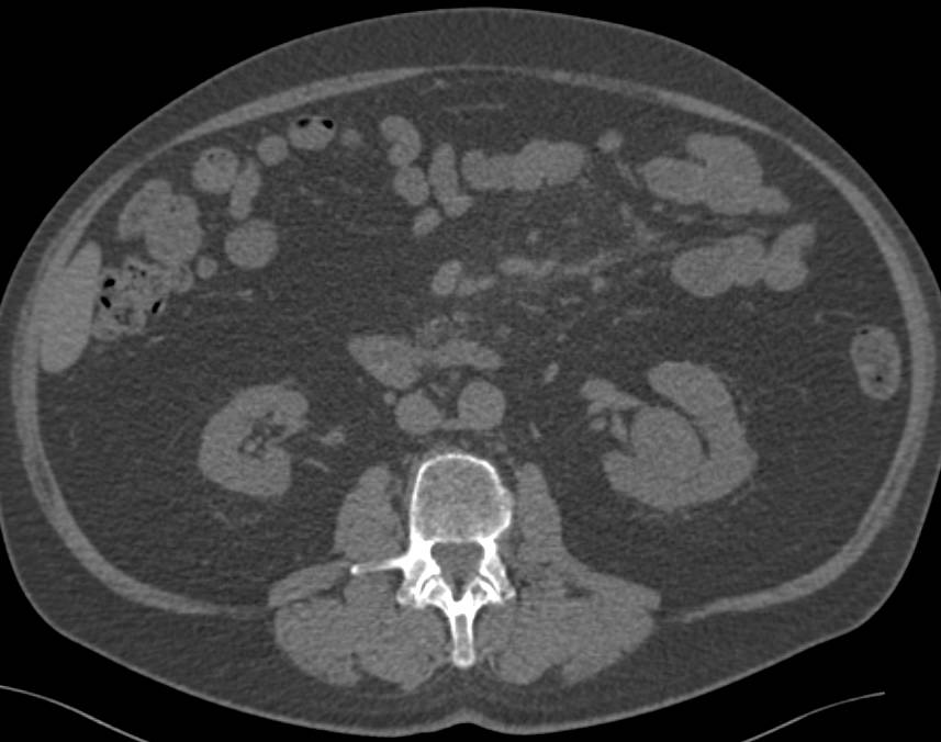 Transitional Cell Carcinoma Left Renal Pelvis - CTisus CT Scan