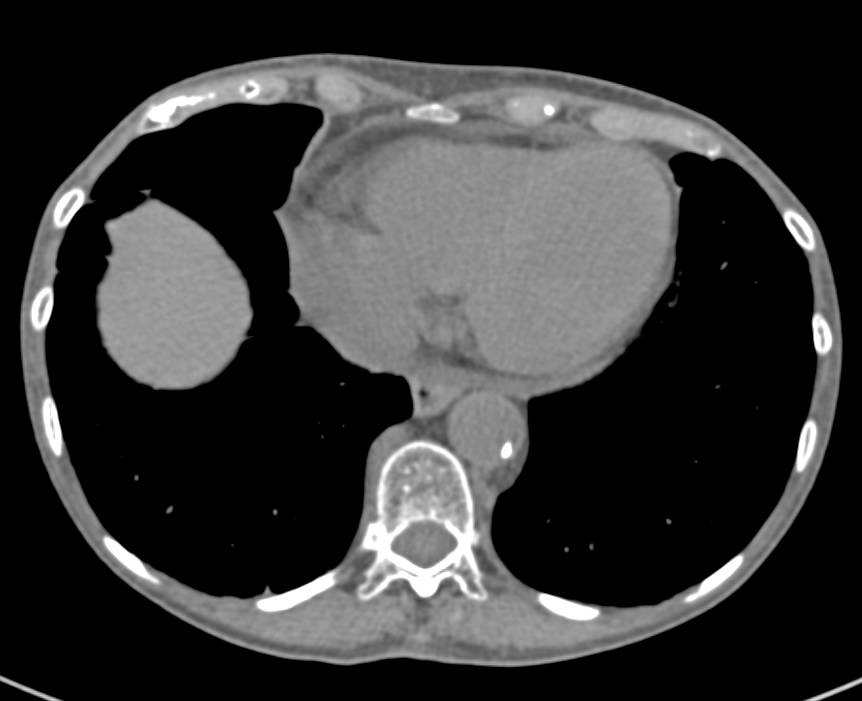 Renal Cell Carcinoma Invades the Renal Vein and Inferior Vena Cava (IVC) and Extends into the Right Atrium. Pulmonary Embolism (PE) also seen. - CTisus CT Scan