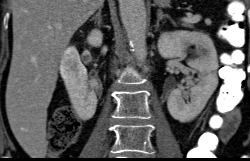 Renal Cell Carcinoma Right Kidney Hidden Among Cysts - CTisus CT Scan