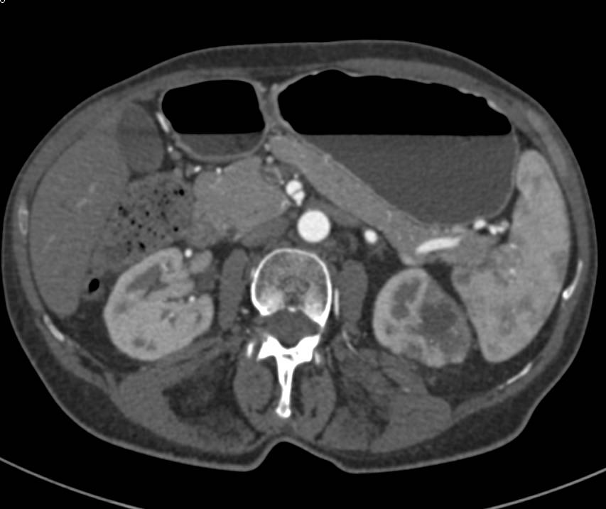 Renal Artery Aneurysm with Renal Infarction - CTisus CT Scan