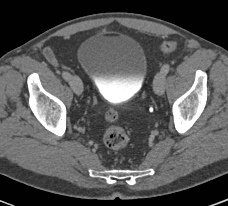 Chyle in Bladder in Patient s/p Laparascopic Partial Nephrectomy - CTisus CT Scan