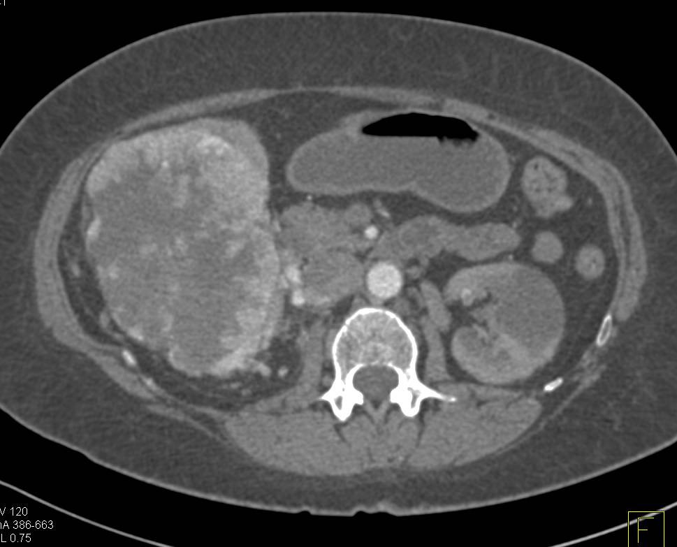 Vascular Renal Cell Carcinoma with Renal Vein Involvement with Extensive Collaterals - CTisus CT Scan