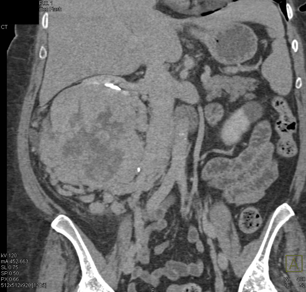 Biulky Renal Cell Carcinoma with Local Adenopathy - CTisus CT Scan