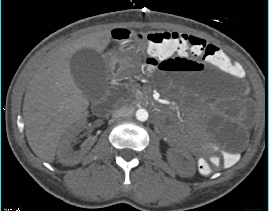 3D of Renal and Pancreatic Transplant - CTisus CT Scan