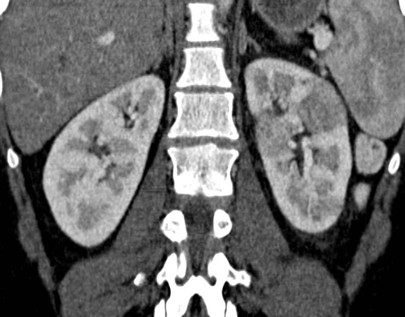 Acute Pyelonephritis Left Kidney With Patchy Enhancement Kidney Case