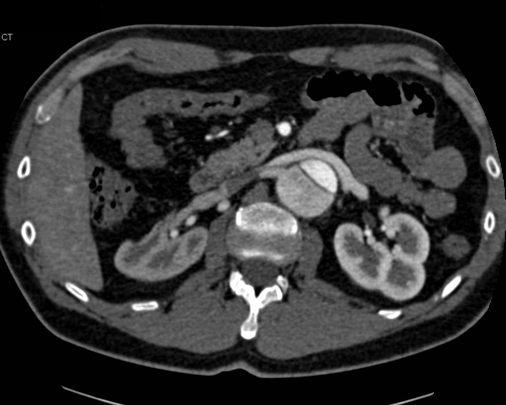 Aortic Dissection with Decreased Right Renal Function as Right Renal Artery Arises off False Lumen - CTisus CT Scan