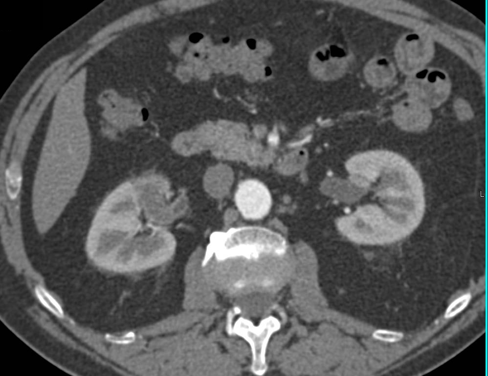 Transitional Cell Carcinoma Right Kidney - CTisus CT Scan