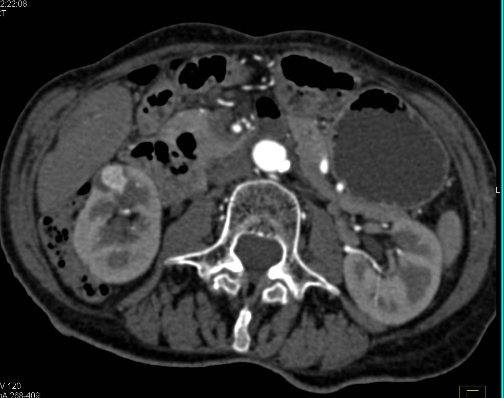 1 cm Right Renal Cell Carcinoma - CTisus CT Scan