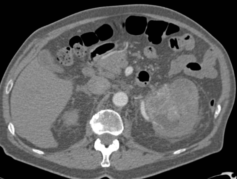 Renal Cell Carcinoma with Embolization - CTisus CT Scan