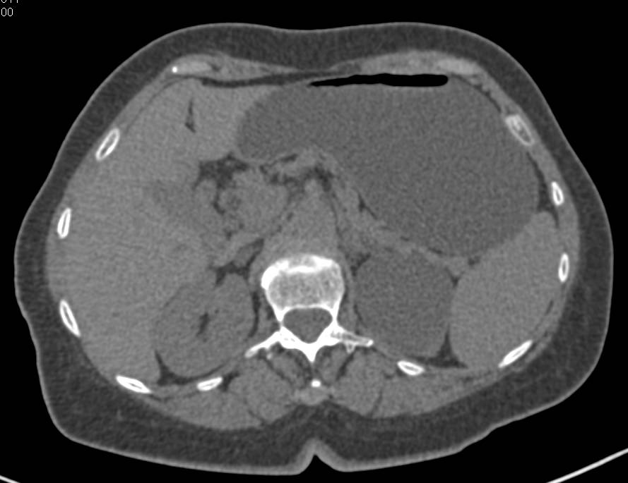 Renal Abscess Simulating a Renal Cell Carcinoma - CTisus CT Scan