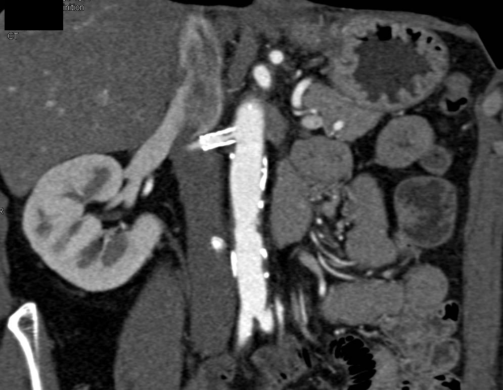 Patent Stent in Right Renal Artery and Occluded Stent in the Left Renal Artery - CTisus CT Scan