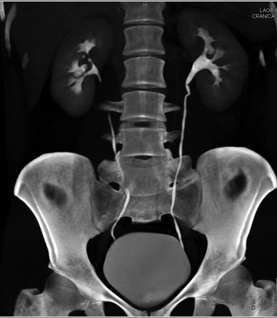 Transitional Cell Cancer (TCC) in Upper Pole of Right Kidney - CTisus CT Scan