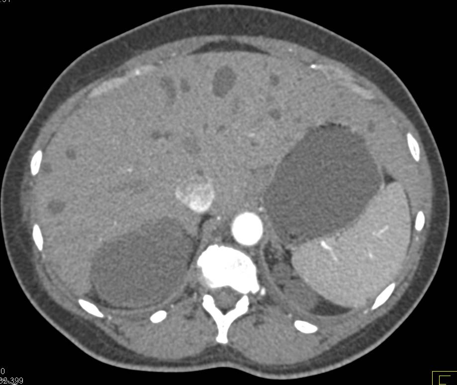 Polycystic Renal Disease and Polycystic Liver Disease - CTisus CT Scan