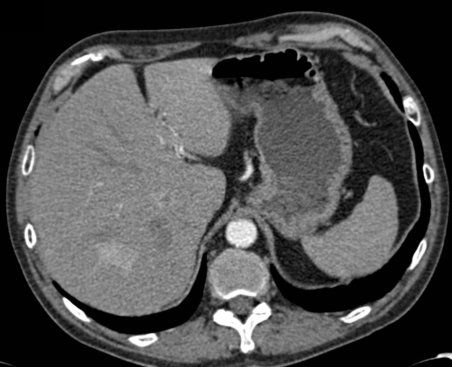 Renal Cell Carcinoma with Liver Metastases and Right Nephrectomy - CTisus CT Scan