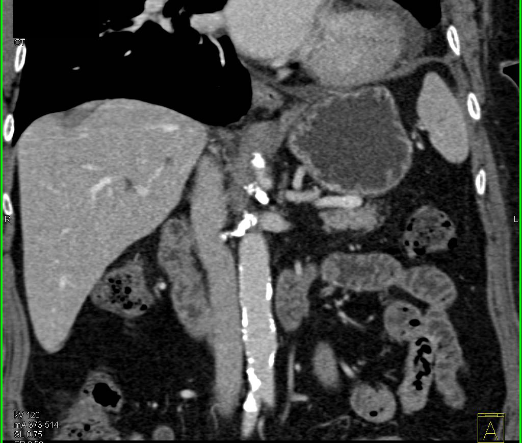 Bilateral Nephrectomies with Anatomy Changes - CTisus CT Scan