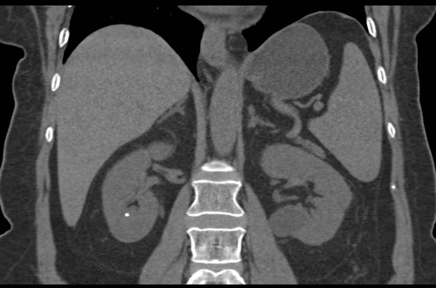 Bosniak ! Cyst - CTisus CT Scan