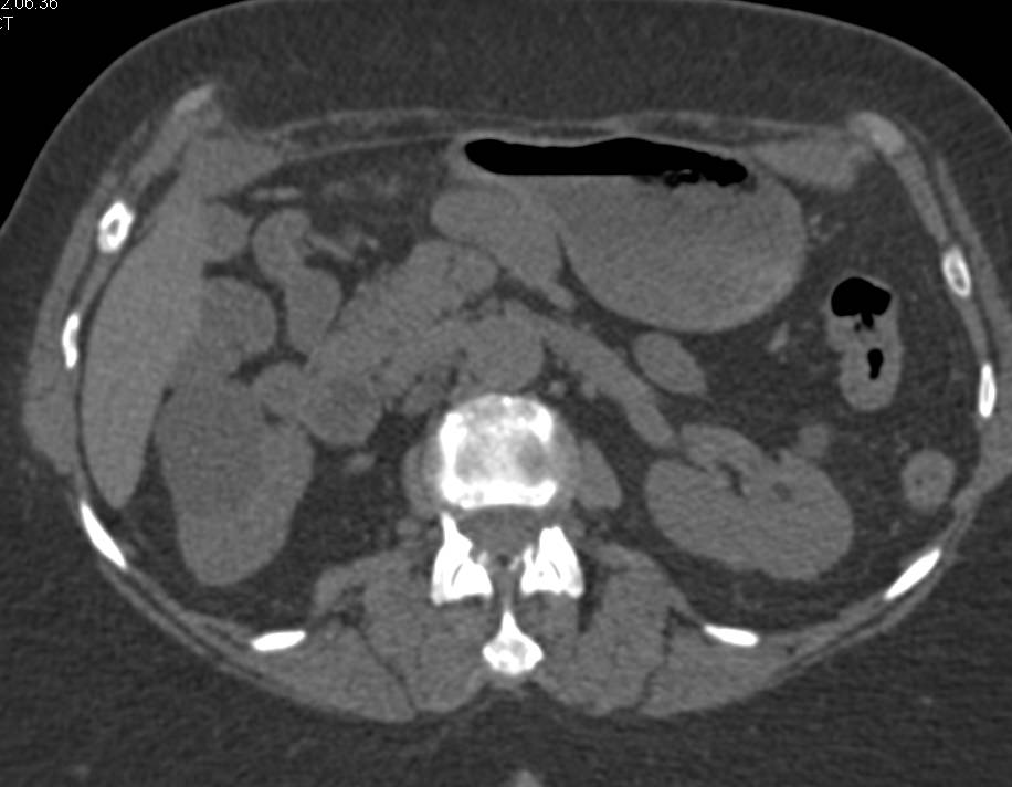 Cystic Papillary Renal Cell Carcinoma Right Kidney with Enhancement - CTisus CT Scan