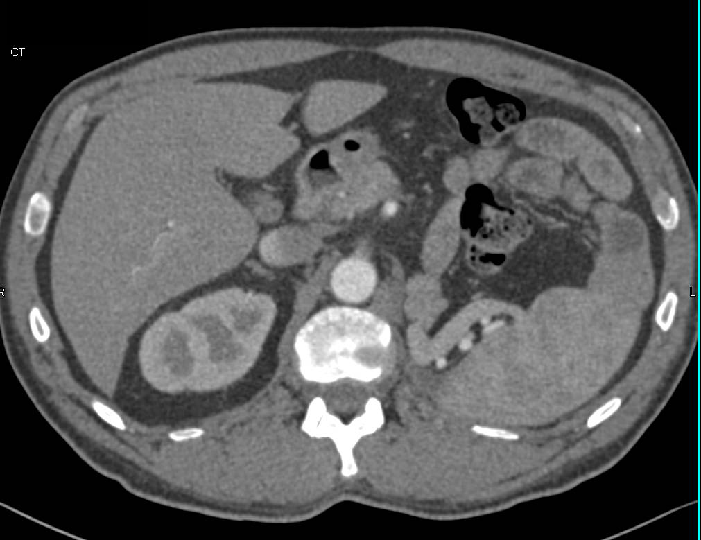 Left Nephrectomy and New Tumor in the Right Kidney - CTisus CT Scan