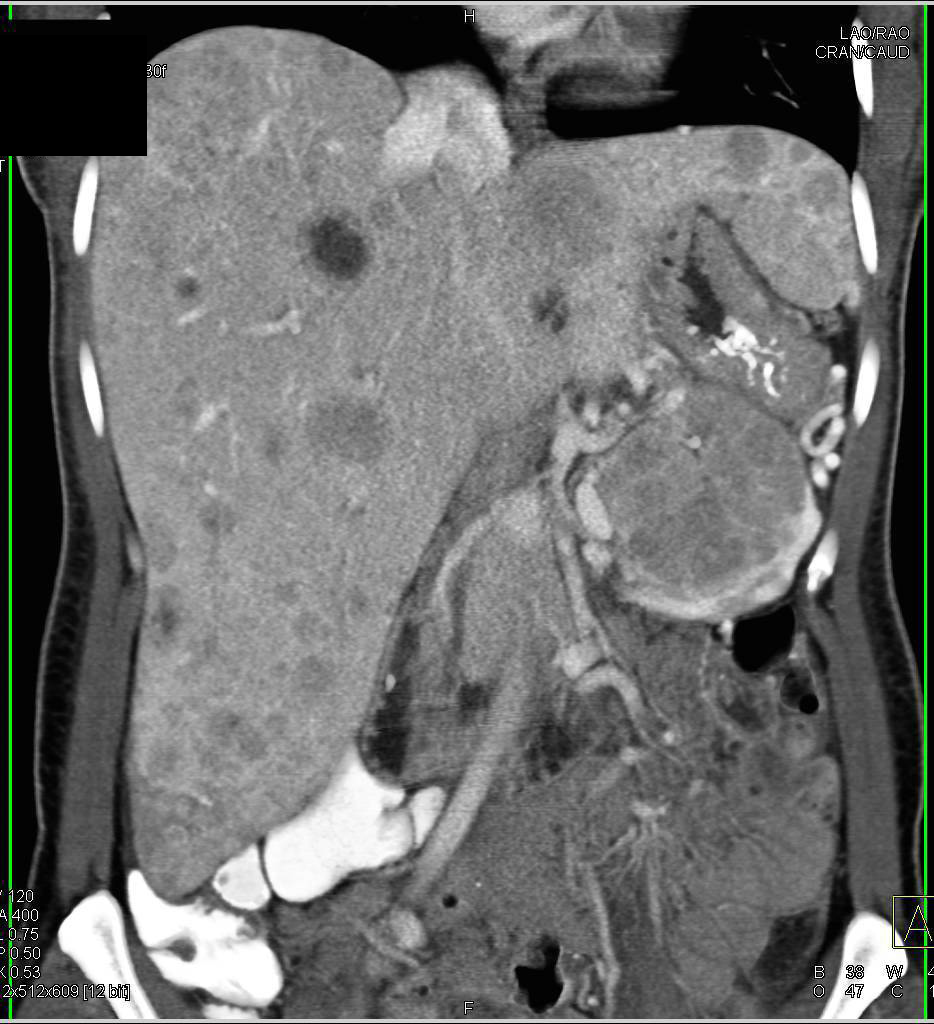 Renal Cell Carcinoma with Vascular Liver Metastases - CTisus CT Scan