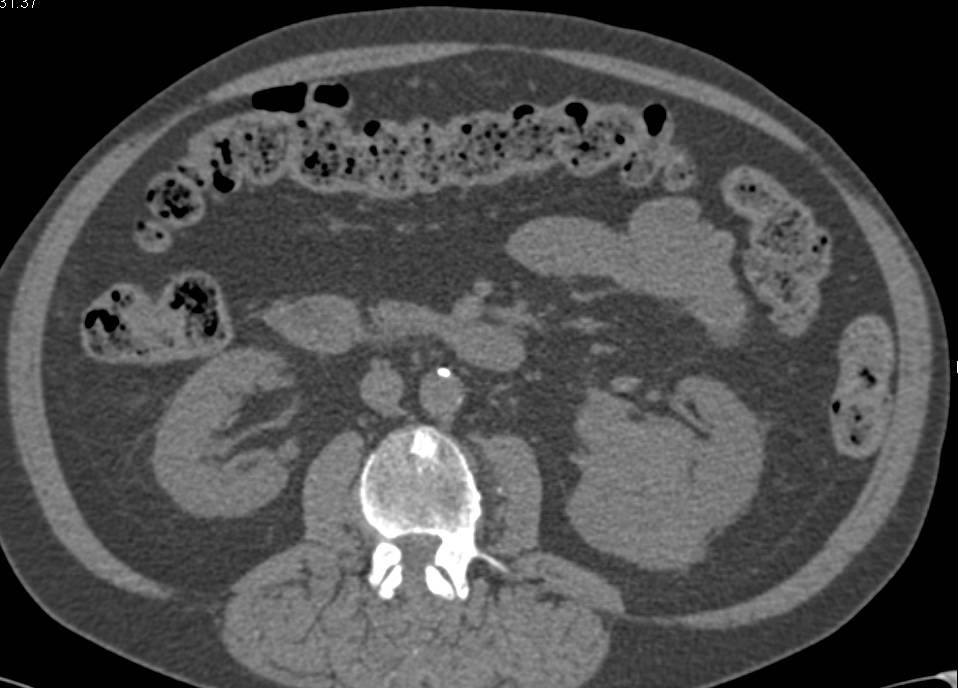 Clear Cell Carcinoma Left Kidney - CTisus CT Scan