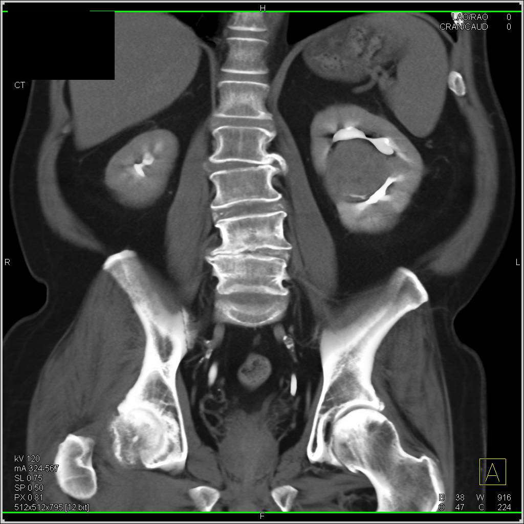 Clear Cell Carcinoma with Rapid Washout of Tumor - CTisus CT Scan