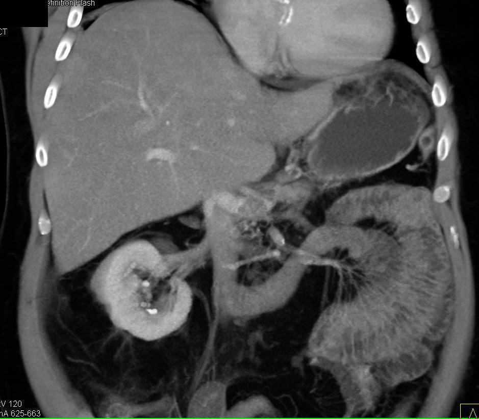 Renal Calculi on Contrast Enhanced Scan - CTisus CT Scan