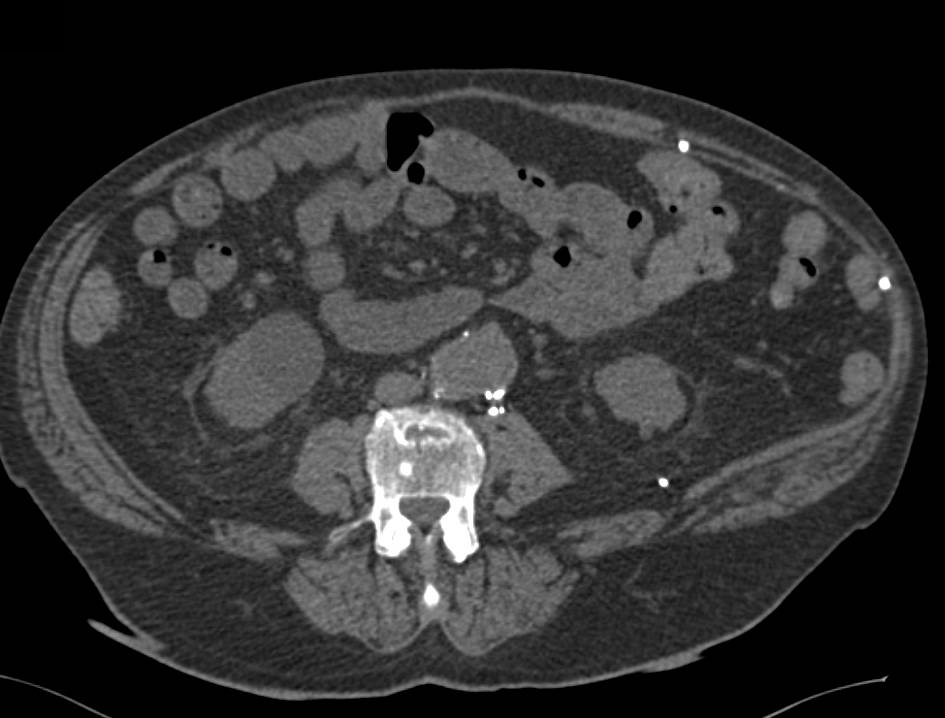 Complex Cysts Right Kidney - CTisus CT Scan