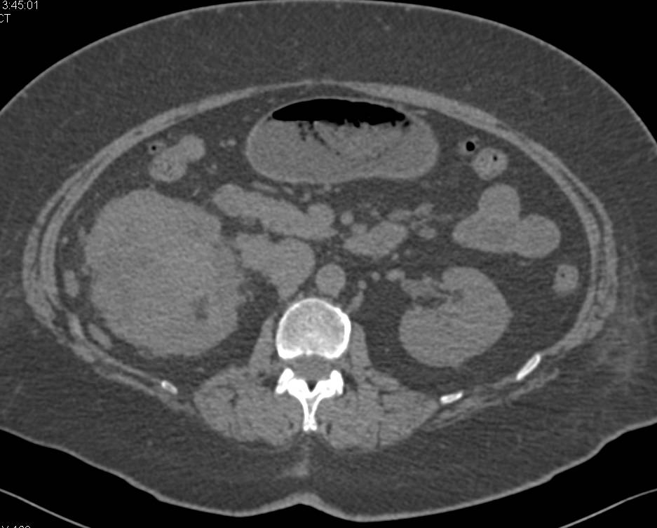 Renal Cell Carcinoma Invades the Renal Vein and Extends into the Inferior Vena Cava (IVC) - CTisus CT Scan