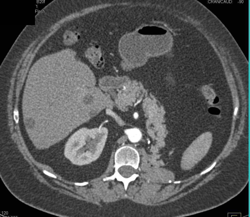 Left Nephrectomy and Ablation Right Kidney - CTisus CT Scan