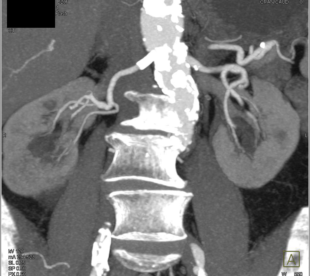 Patent Stent in Right Renal Artery - CTisus CT Scan