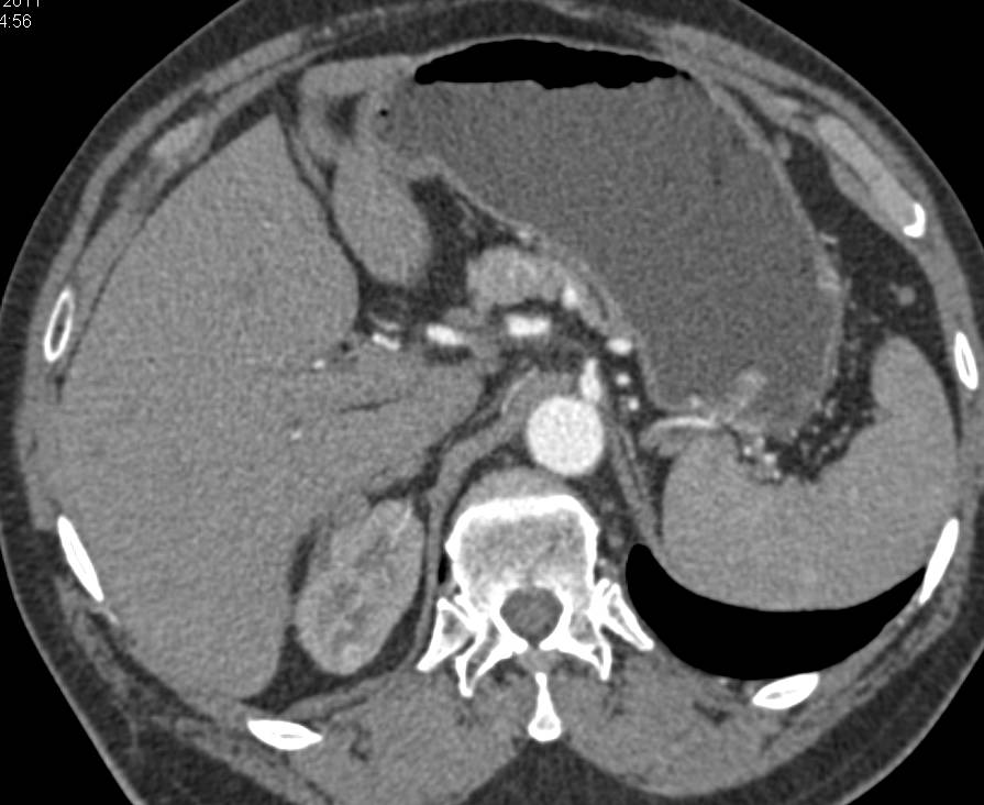 Partial Nephrectomy Bilaterally with No Recurrence - CTisus CT Scan