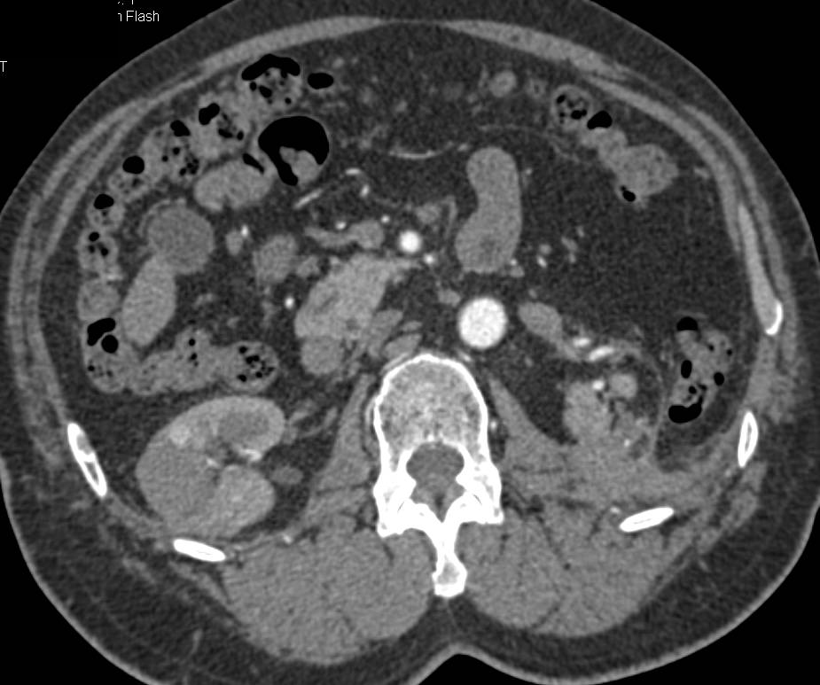 Scarring and Poor Function Left Kidney and Pyelonephritis Right Kidney - CTisus CT Scan