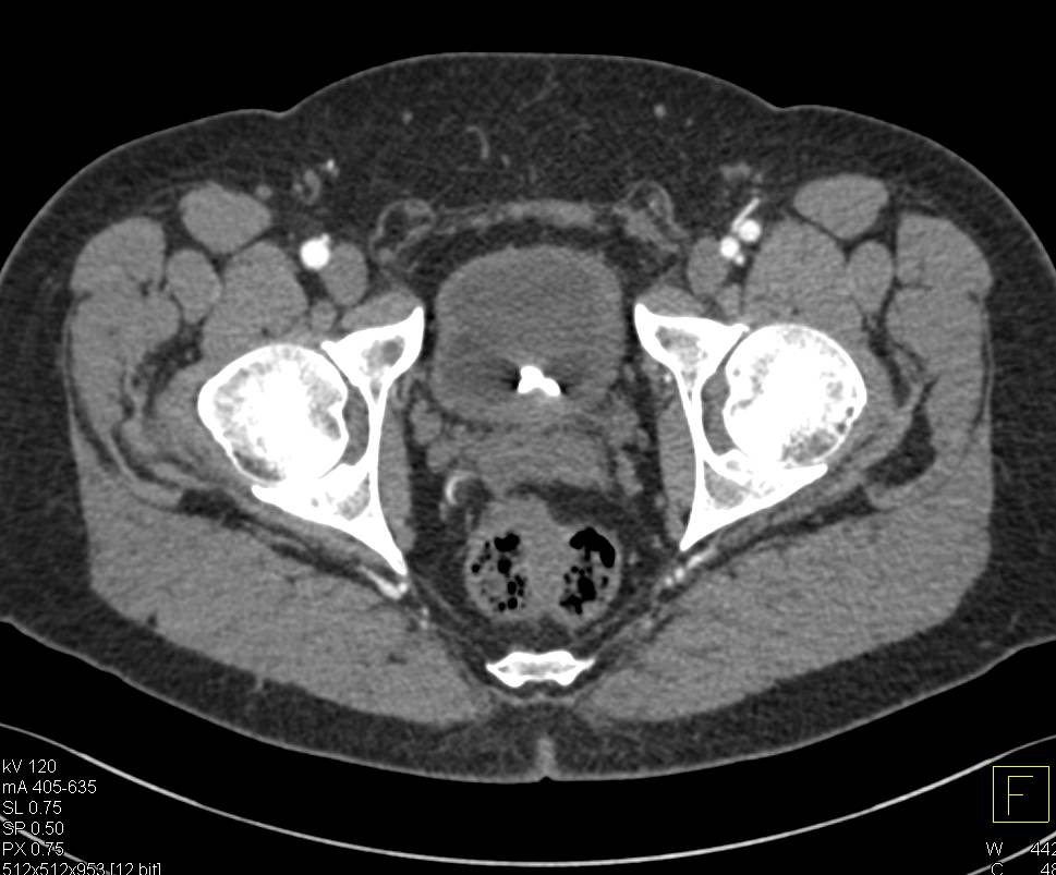 Transitional Cell Carcinoma Left Kidney with Stent in Place - CTisus CT Scan