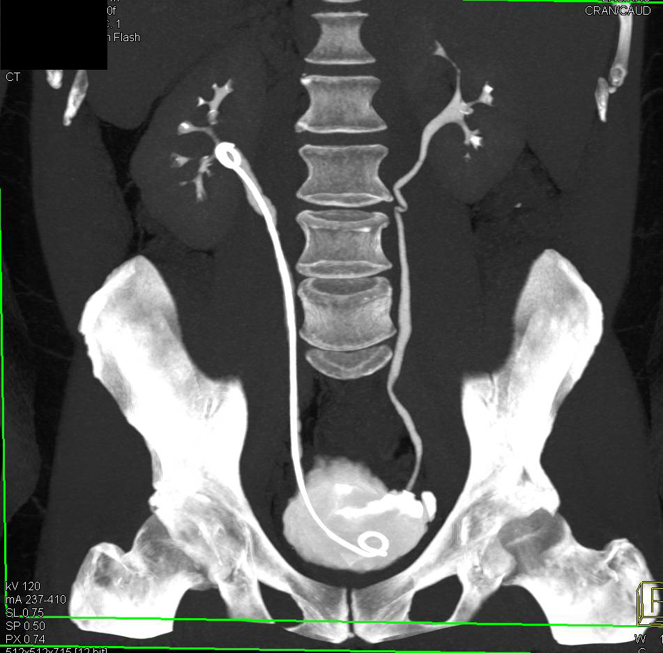 Bladder Cancer Near Left Ureterovesical Junction (UVJ) with a Stent in Place - CTisus CT Scan