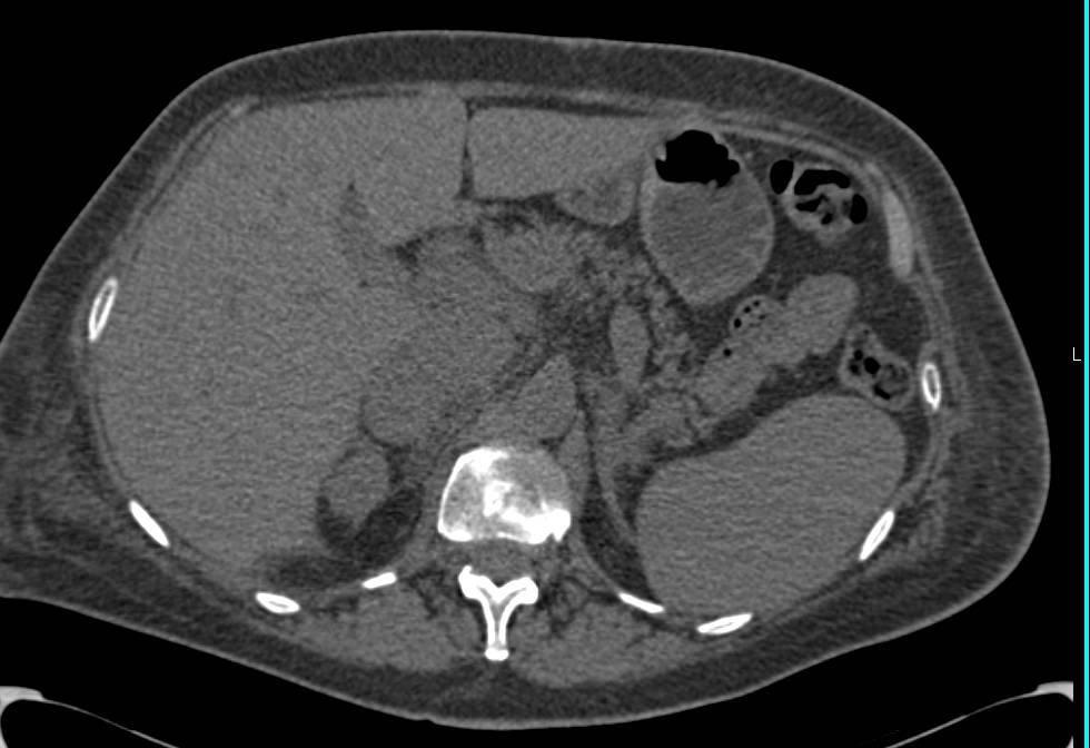 Stage IV Renal Cell Carcinoma Invades Inferior Vena Cava (IVC), Spine and Has Extensive Adenopathy - CTisus CT Scan