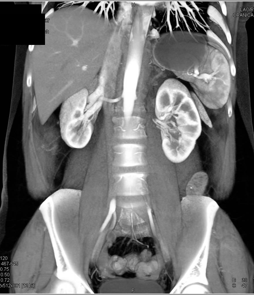 Renal Donor with Normal Arterial and Venous Anatomy - CTisus CT Scan