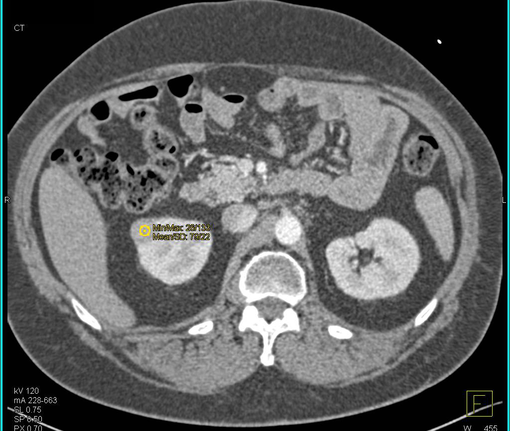 1 cm Renal Cell Carcinoma Lateral Aspect Right Kidney - CTisus CT Scan