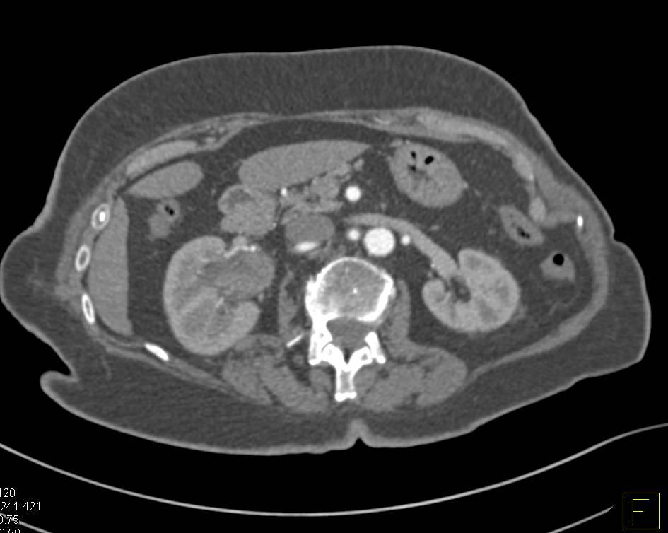 Transitional Cell Carcinoma Right Renal Pelvis - CTisus CT Scan