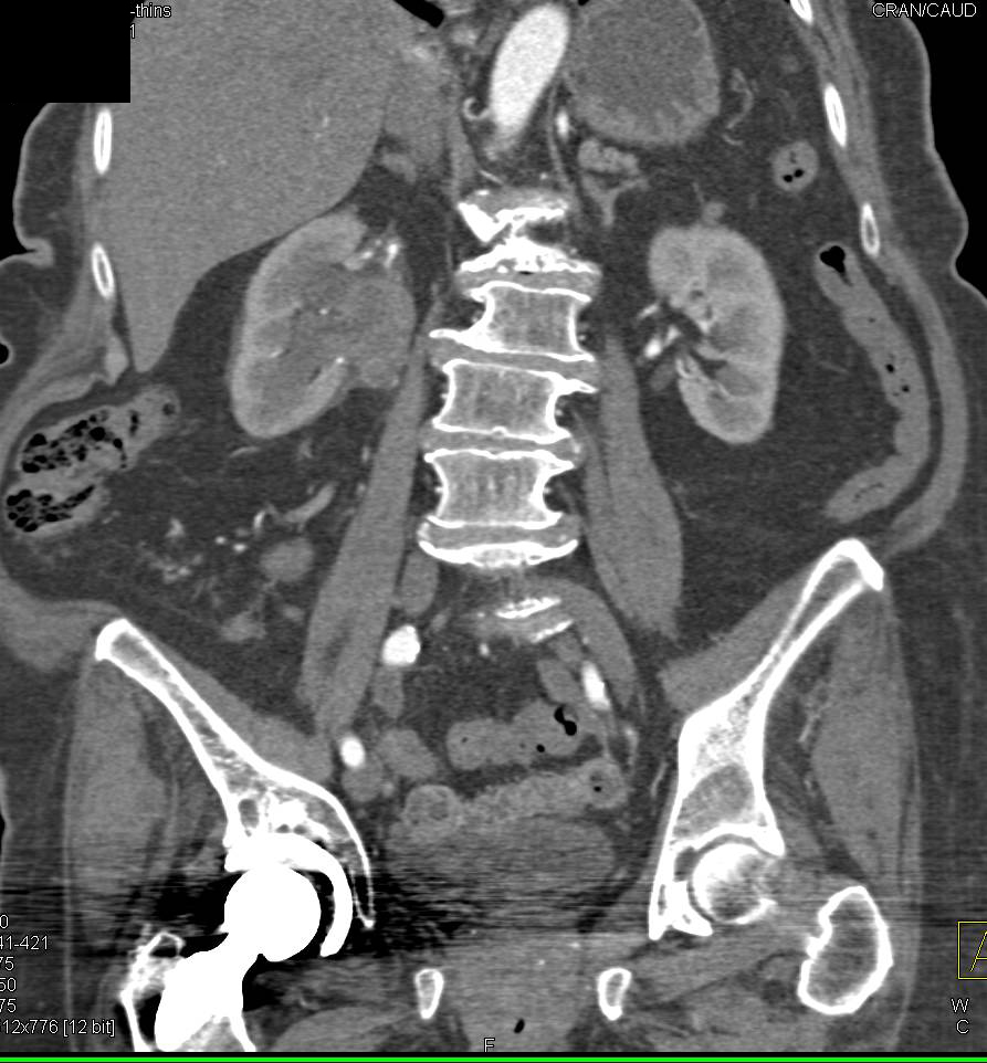 Transitional Cell Carcinoma - CTisus CT Scan