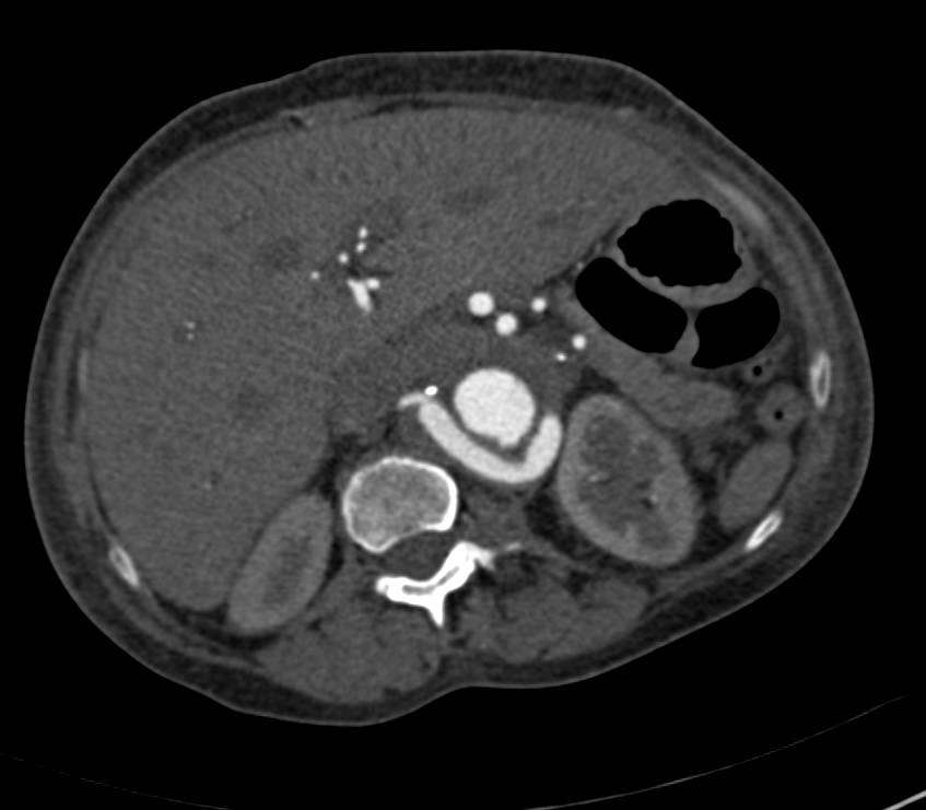 3D Map of a Reimplanted Left Renal Artery - CTisus CT Scan