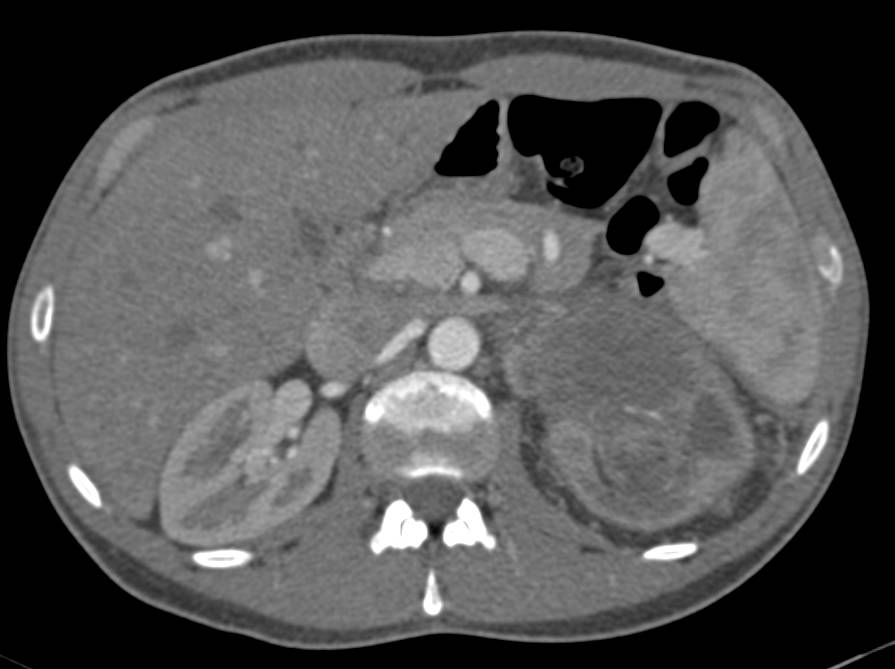 Infiltrating Tumor Left Kidney was a Renal Cell Carcinoma - CTisus CT Scan