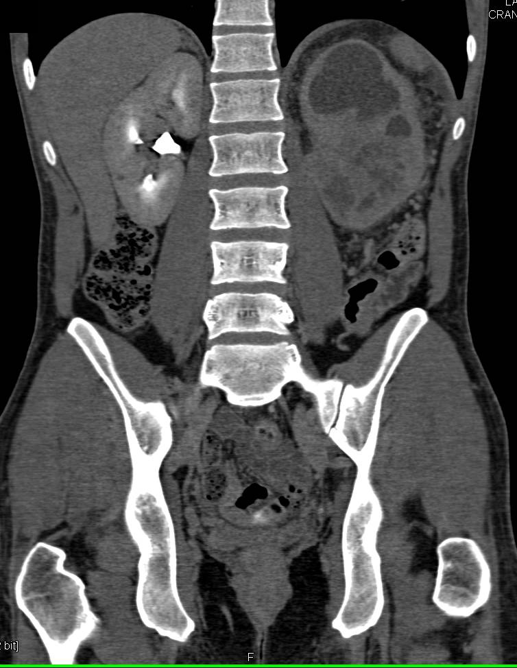 Infiltrating Transitional Cell Carcinoma Left Kidney - CTisus CT Scan