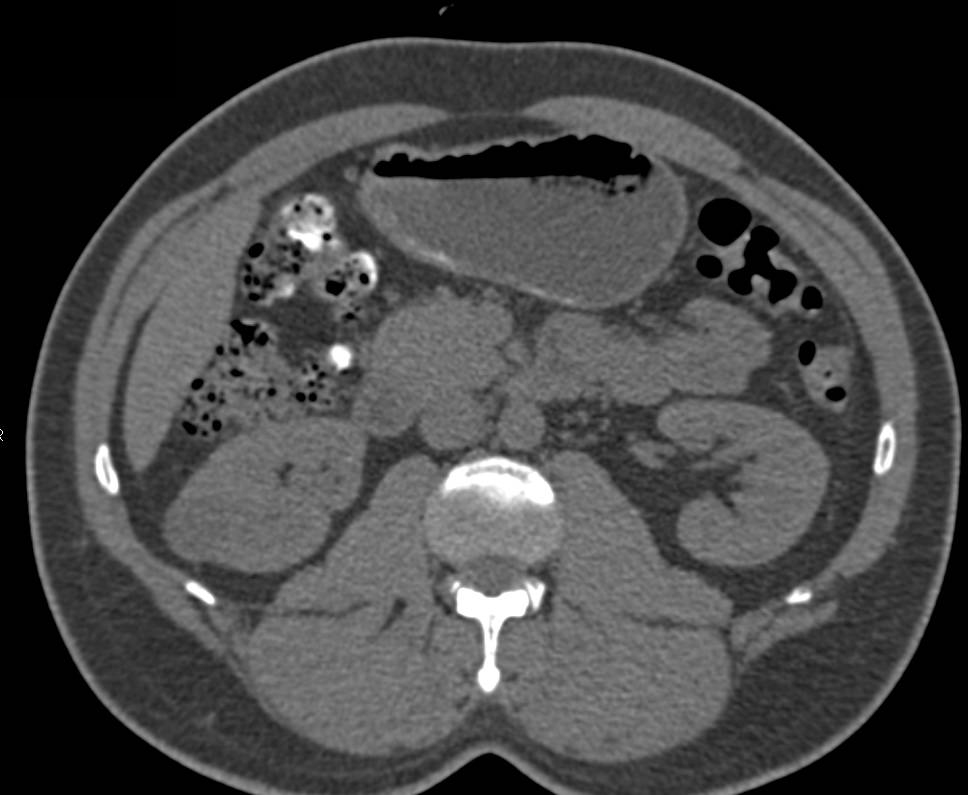 Cystic Renal Cell Carcinoma - CTisus CT Scan